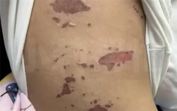 3岁男童吃火锅烫嘴后竟全身溃烂 医生:有传染性