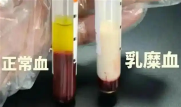 男子抽出草莓奶油血 医生紧急提醒：血脂长期偏高要注意