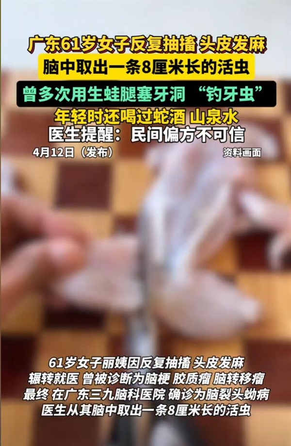 女子听信偏方:脑内取出8厘米活虫