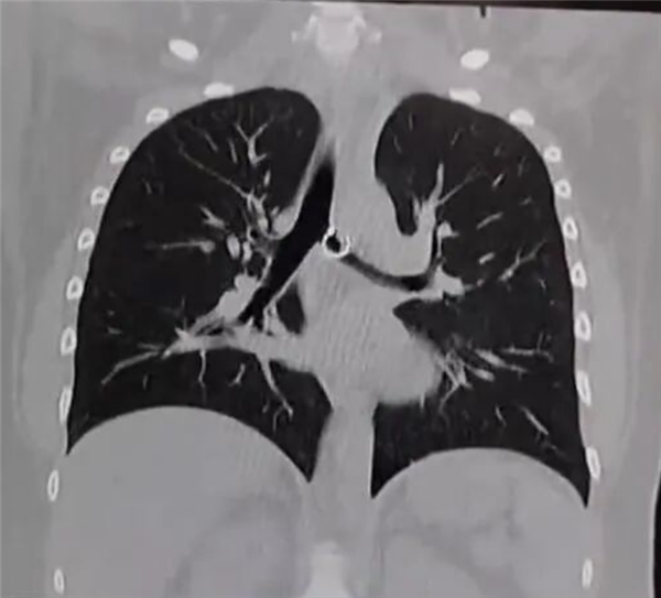 女子咳嗽一个月肺里惊现丢失鼻环 距离死亡仅剩0.5mm！