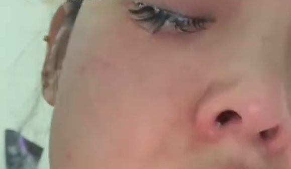 女子误将502喷入眼中睫毛全被拔 就医后保住视力